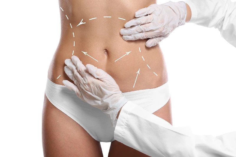 Liposuction